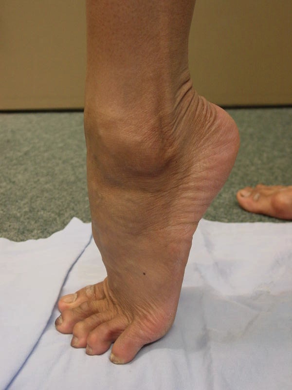 Peroneal Tendon Dislocation 1